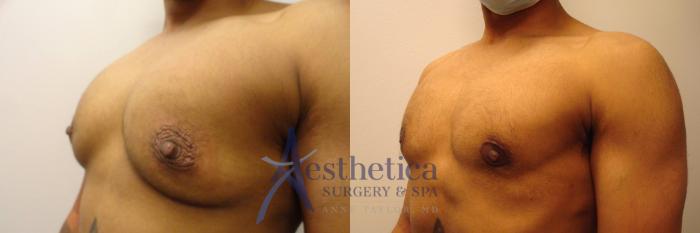 Transgender Top Surgery (FTM/MTF) Case 321 Before & After View #2 | Columbus, OH | Aesthetica Surgery & Spa