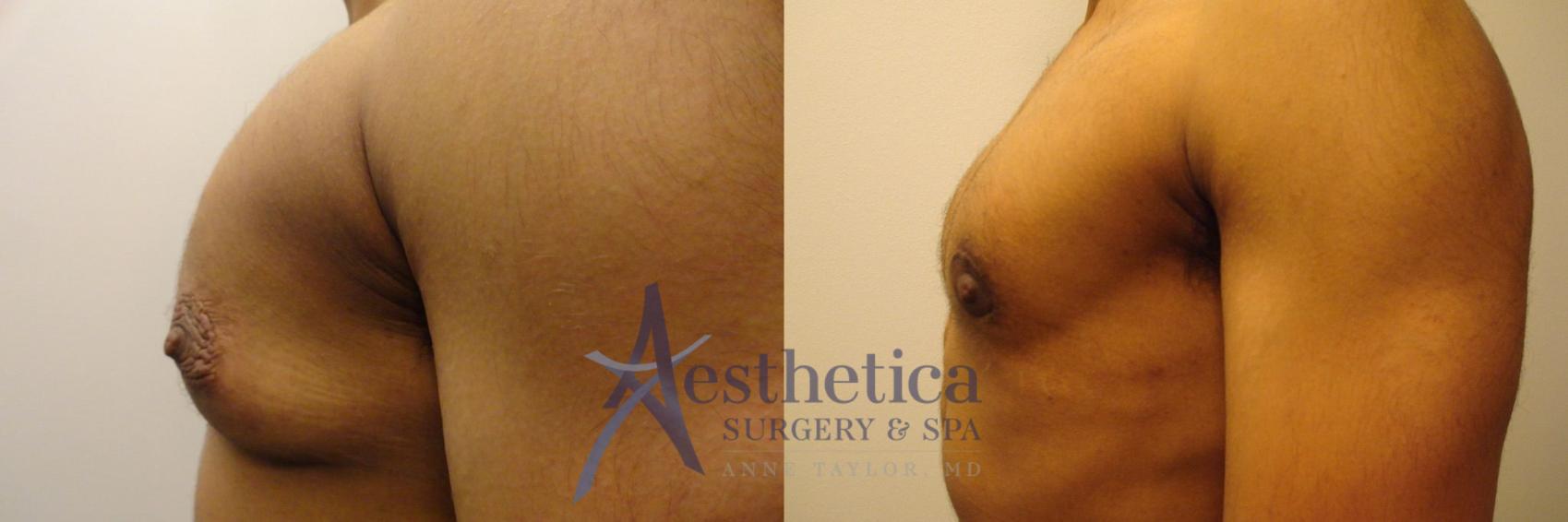 Transgender Top Surgery (FTM/MTF) Case 321 Before & After View #3 | Columbus, OH | Aesthetica Surgery & Spa