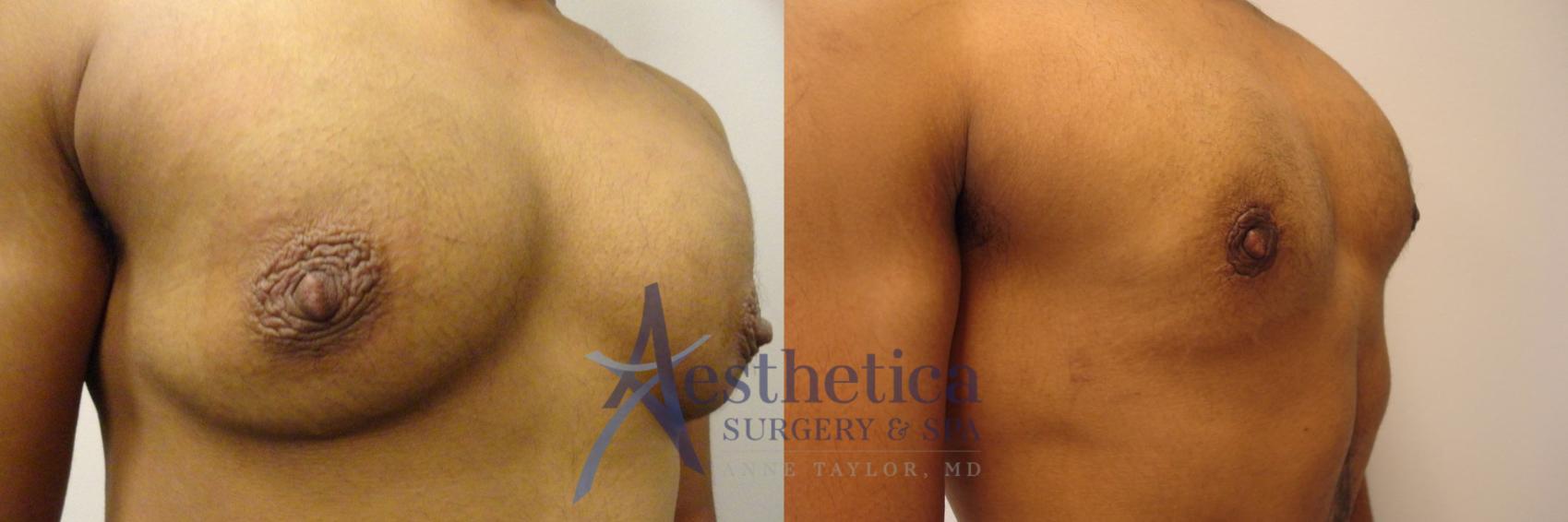 Transgender Top Surgery (FTM/MTF) Case 321 Before & After View #4 | Columbus, OH | Aesthetica Surgery & Spa