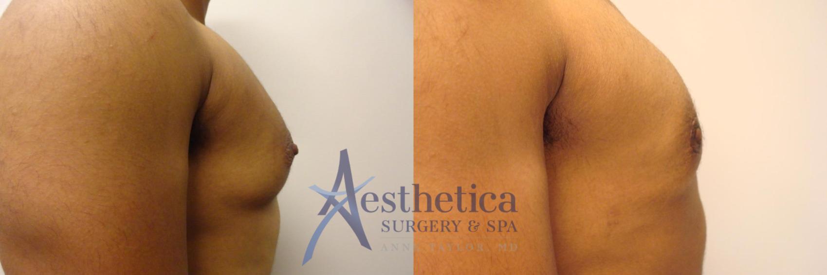 Transgender Top Surgery (FTM/MTF) Case 321 Before & After View #5 | Columbus, OH | Aesthetica Surgery & Spa