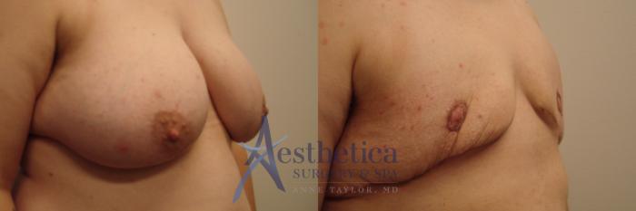 Transgender Top Surgery (FTM/MTF) Case 435 Before & After Right Oblique | Columbus, OH | Aesthetica Surgery & Spa