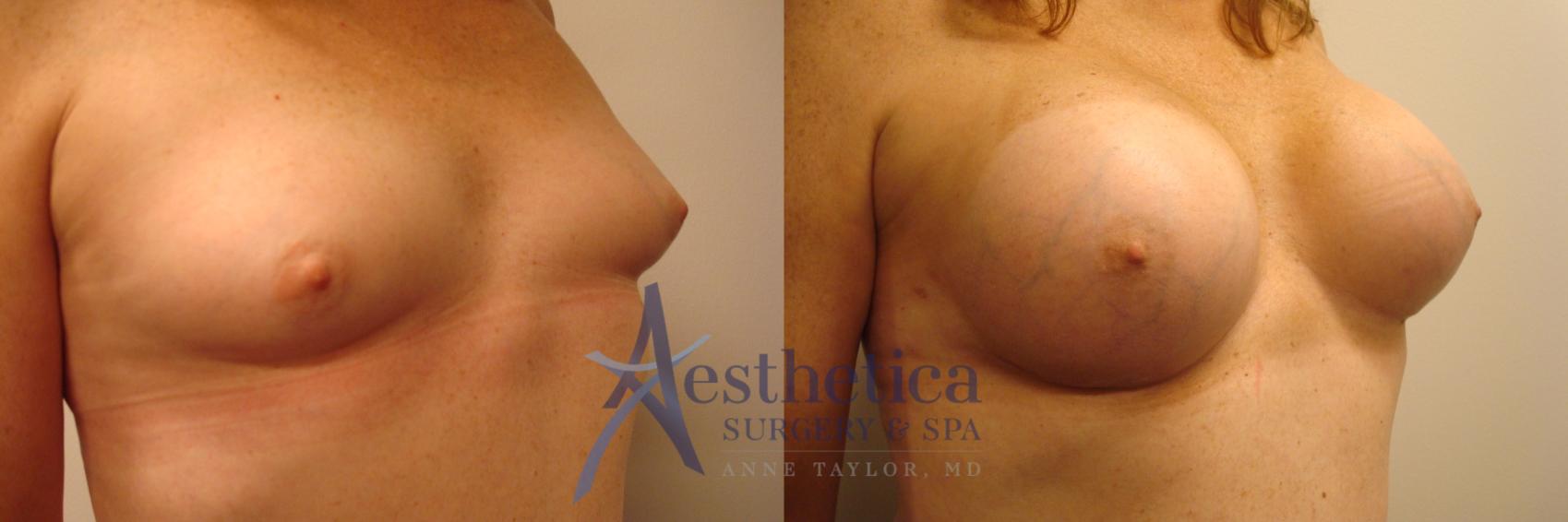 Transgender Top Surgery (FTM/MTF) Case 450 Before & After Right Oblique | Columbus, OH | Aesthetica Surgery & Spa
