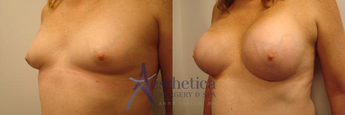 Transgender Top Surgery (FTM/MTF) Case 460 Before & After Left Oblique | Columbus, OH | Aesthetica Surgery & Spa