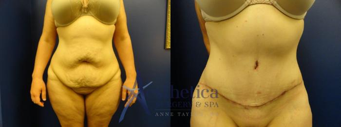 Tummy Tuck Case 132 Before & After View #1 | Columbus, OH | Aesthetica Surgery & Spa