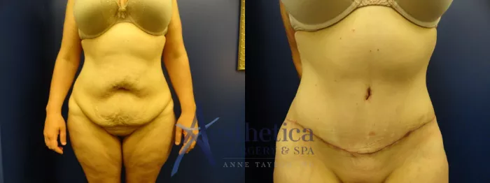 Tummy Tuck Before & After Photos Patient 132