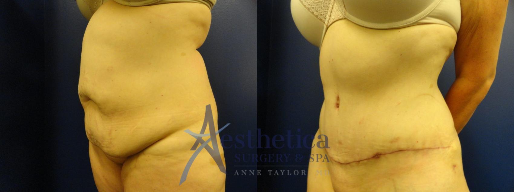 Tummy Tuck Case 132 Before & After View #2 | Columbus, OH | Aesthetica Surgery & Spa