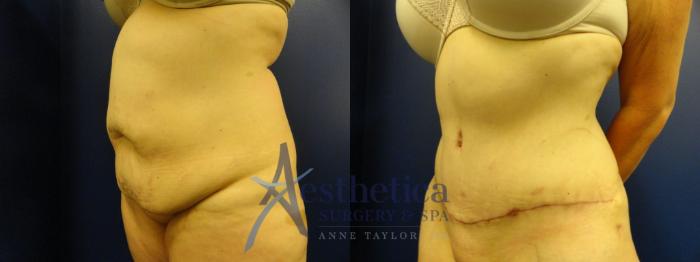 Tummy Tuck Case 132 Before & After View #2 | Columbus, OH | Aesthetica Surgery & Spa