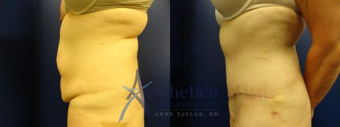 Tummy Tuck Case 132 Before & After View #3 | Columbus, OH | Aesthetica Surgery & Spa