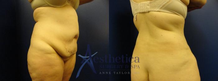 Tummy Tuck Case 132 Before & After View #4 | Columbus, OH | Aesthetica Surgery & Spa
