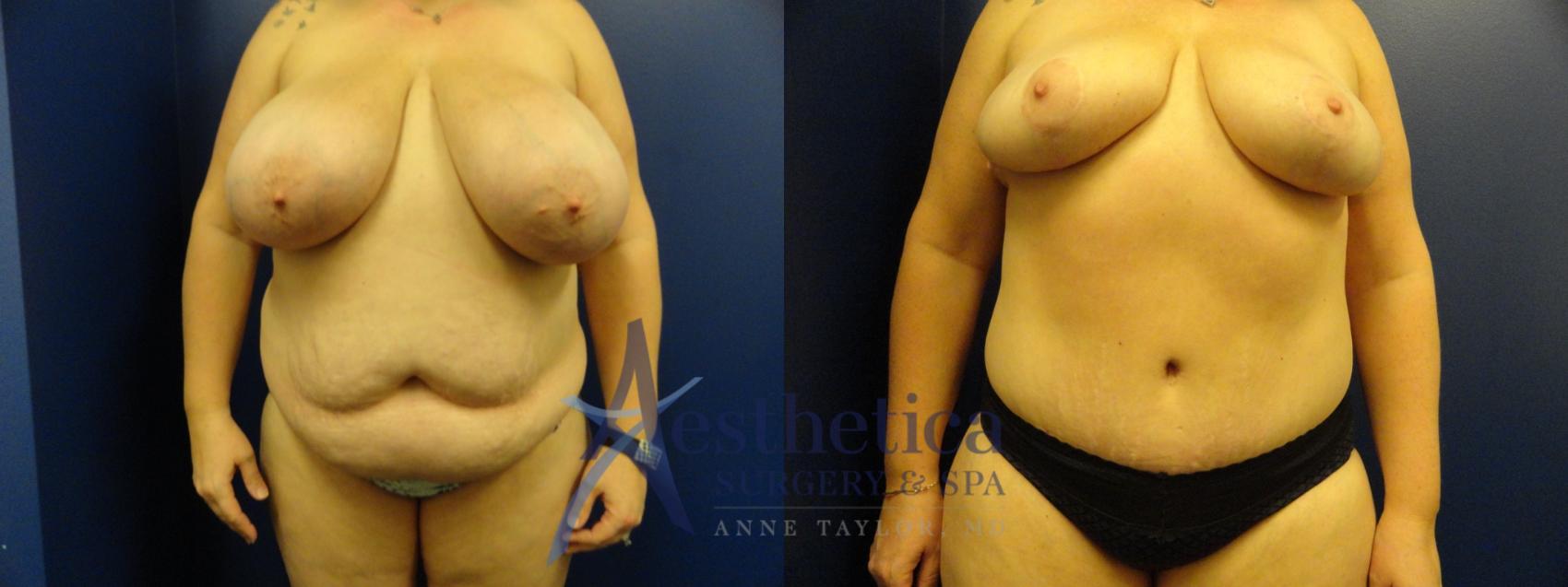 Breast Reduction Case 151 Before & After View #1 | Columbus, OH | Aesthetica Surgery & Spa