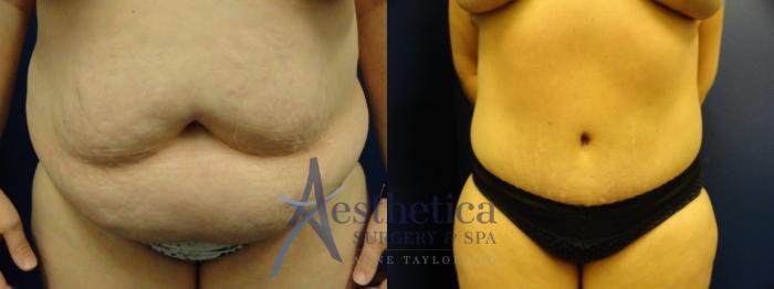 Liposuction Case 151 Before & After View #2 | Columbus, OH | Aesthetica Surgery & Spa