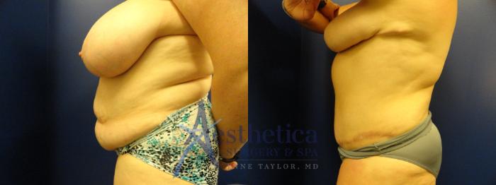 Liposuction Case 151 Before & After View #3 | Columbus, OH | Aesthetica Surgery & Spa