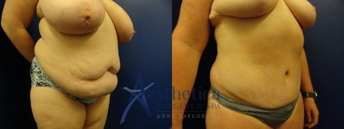 Breast Reduction Case 151 Before & After View #4 | Columbus, OH | Aesthetica Surgery & Spa