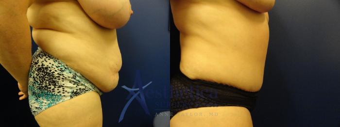Breast Reduction Case 151 Before & After View #5 | Columbus, OH | Aesthetica Surgery & Spa