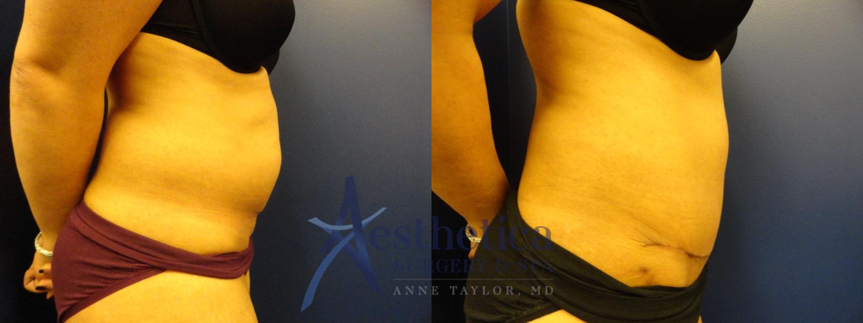 Tummy Tuck Case 152 Before & After View #2 | Columbus, OH | Aesthetica Surgery & Spa