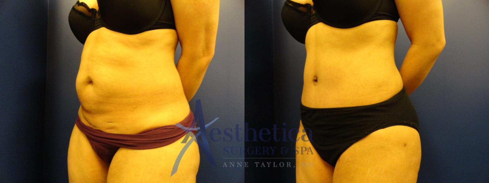 Tummy Tuck Case 152 Before & After View #3 | Columbus, OH | Aesthetica Surgery & Spa
