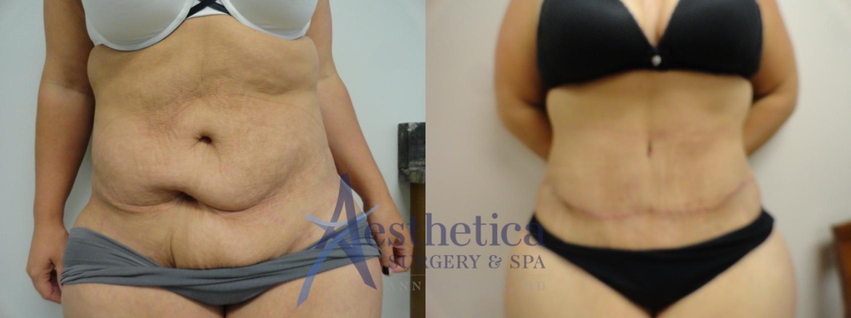 Tummy Tuck Case 16 Before & After View #1 | Worthington, OH | Aesthetica Surgery & Spa