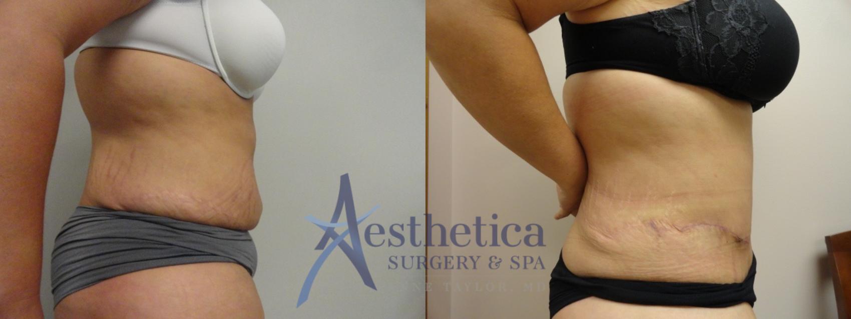 Tummy Tuck Case 16 Before & After View #2 | Worthington, OH | Aesthetica Surgery & Spa