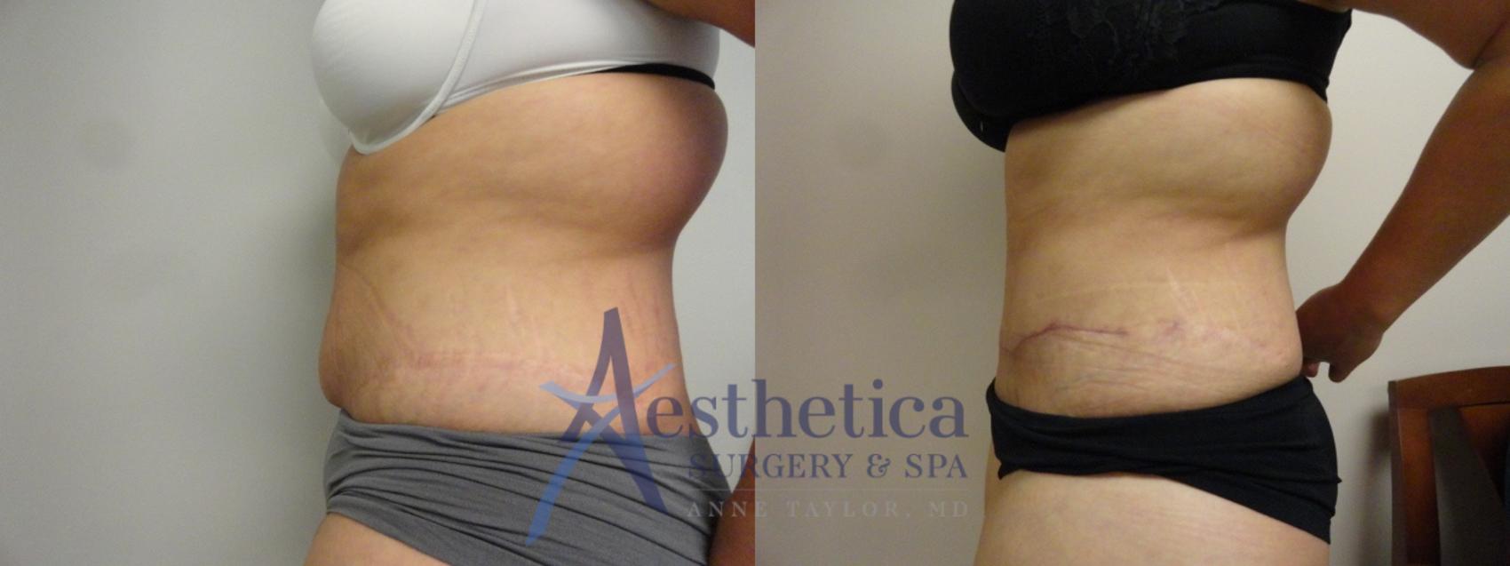 Tummy Tuck Case 16 Before & After View #3 | Worthington, OH | Aesthetica Surgery & Spa