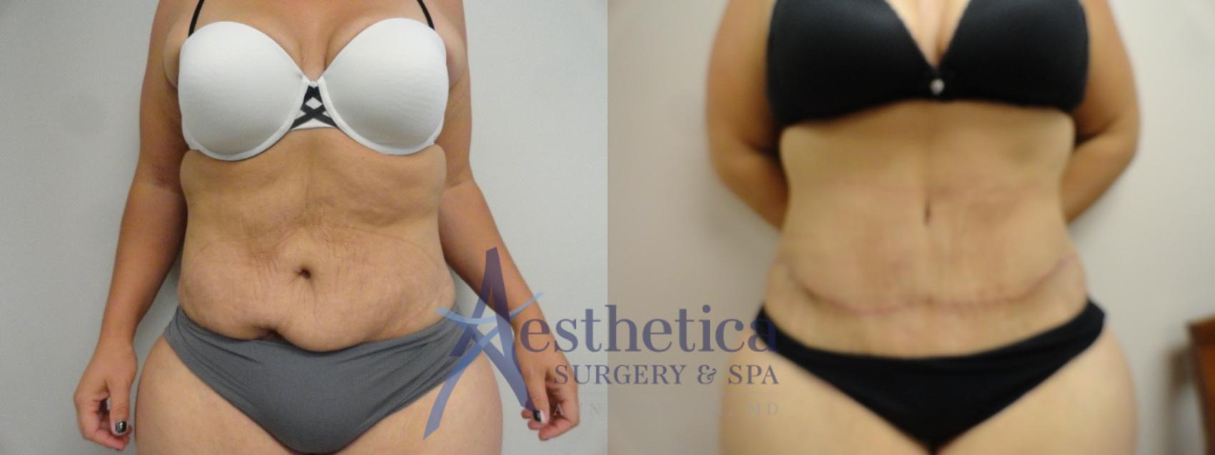 Tummy Tuck Case 16 Before & After View #4 | Worthington, OH | Aesthetica Surgery & Spa