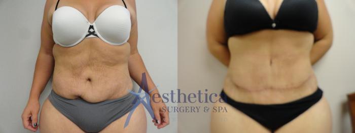 Tummy Tuck Case 16 Before & After View #4 | Columbus, OH | Aesthetica Surgery & Spa