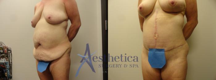 Tummy Tuck Case 164 Before & After View #2 | Columbus, OH | Aesthetica Surgery & Spa