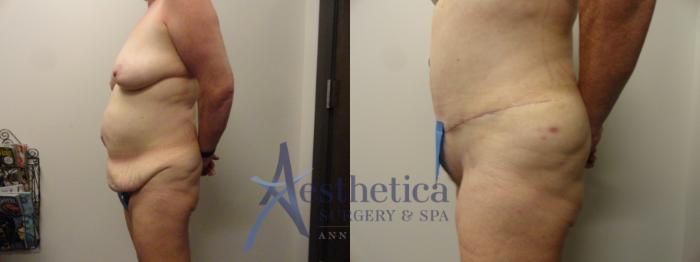 Tummy Tuck Case 164 Before & After View #3 | Columbus, OH | Aesthetica Surgery & Spa