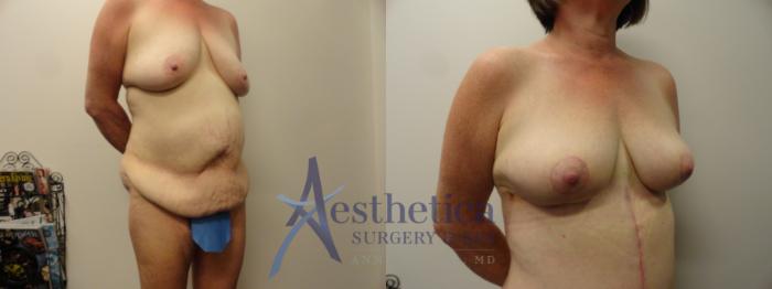 Tummy Tuck Case 164 Before & After View #4 | Columbus, OH | Aesthetica Surgery & Spa