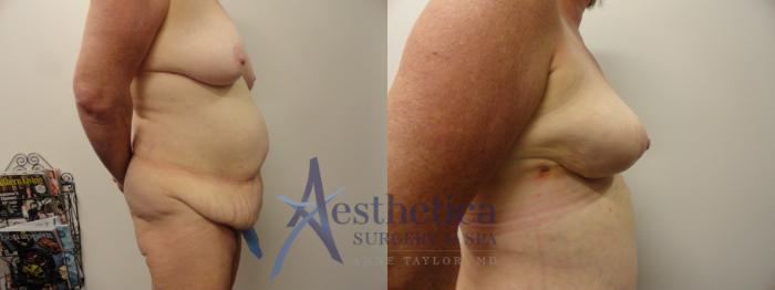 Tummy Tuck Case 164 Before & After View #5 | Columbus, OH | Aesthetica Surgery & Spa