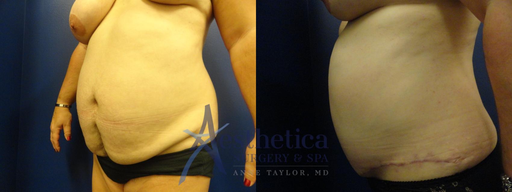 Tummy Tuck Case 176 Before & After View #2 | Worthington, OH | Aesthetica Surgery & Spa