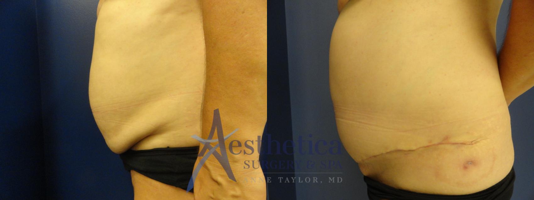 Tummy Tuck Case 176 Before & After View #3 | Worthington, OH | Aesthetica Surgery & Spa