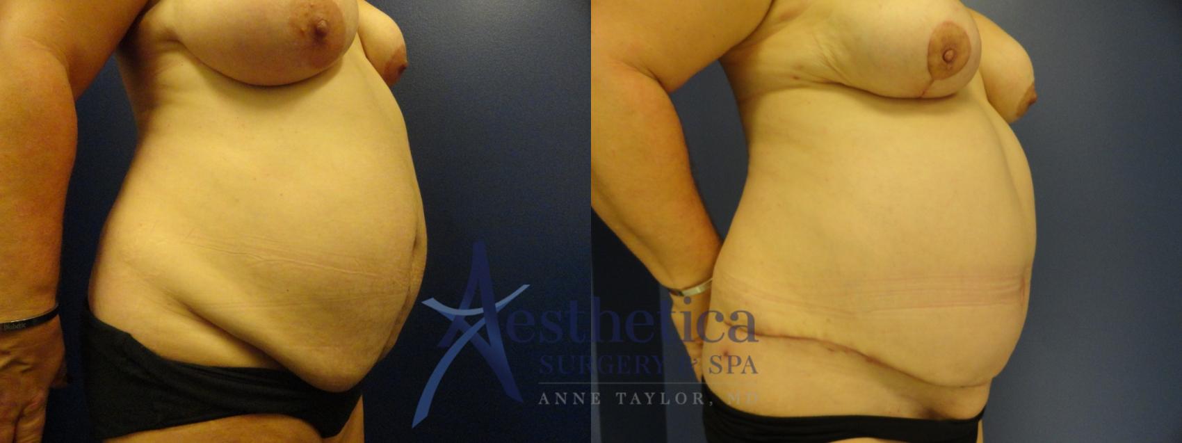 Tummy Tuck Case 176 Before & After View #4 | Worthington, OH | Aesthetica Surgery & Spa