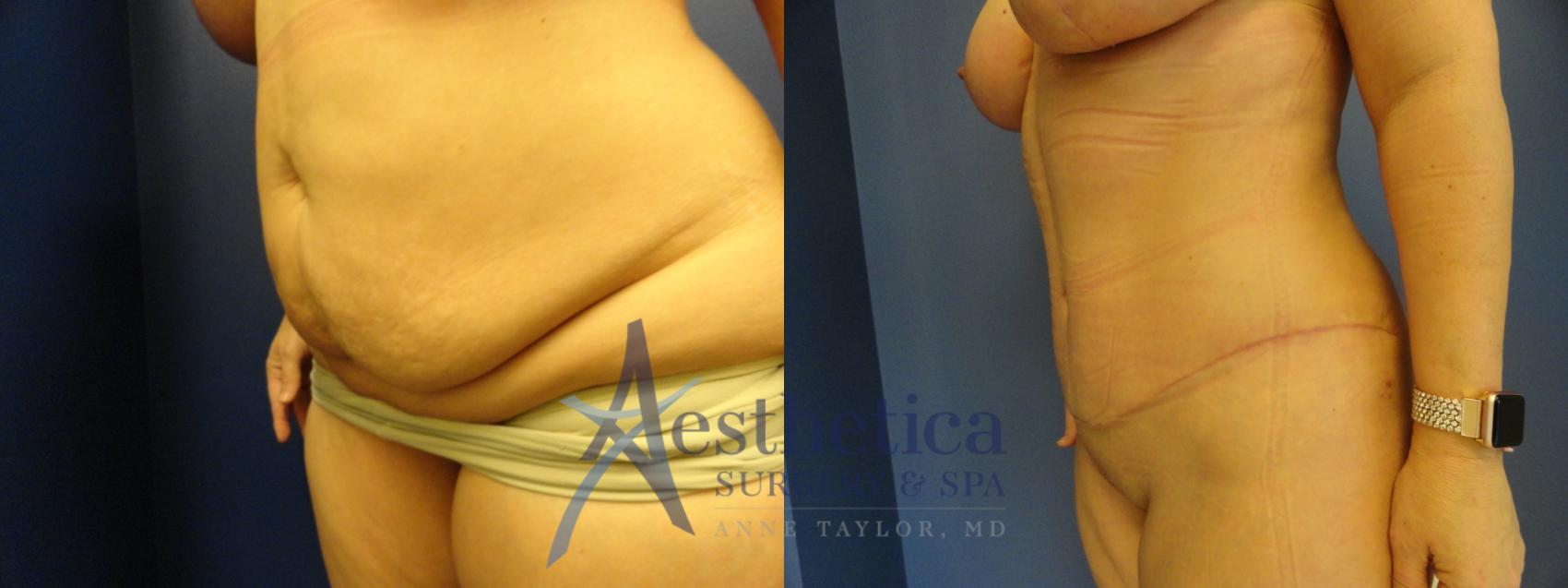 Tummy Tuck Case 184 Before & After View #2 | Columbus, OH | Aesthetica Surgery & Spa