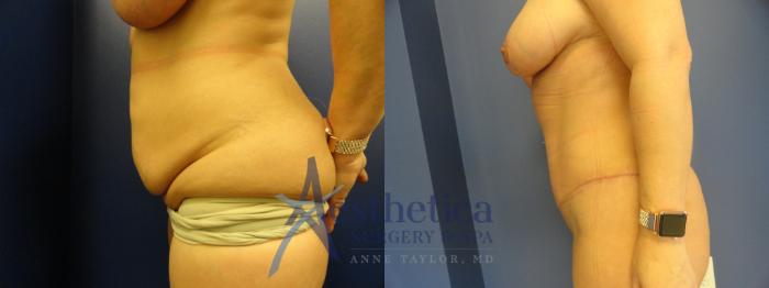 Tummy Tuck Case 184 Before & After View #3 | Columbus, OH | Aesthetica Surgery & Spa