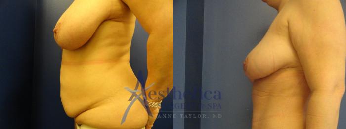 Tummy Tuck Case 184 Before & After View #4 | Columbus, OH | Aesthetica Surgery & Spa