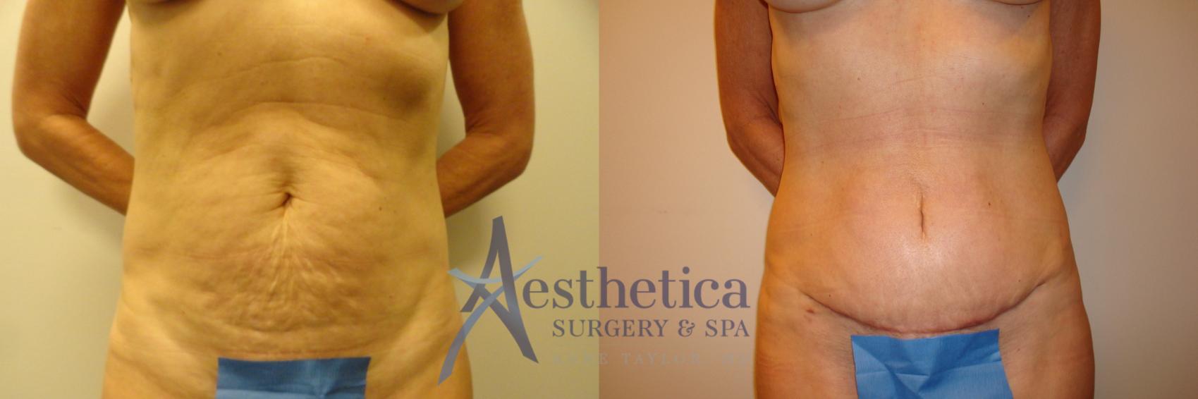 Tummy Tuck Case 197 Before & After View #1 | Columbus, OH | Aesthetica Surgery & Spa