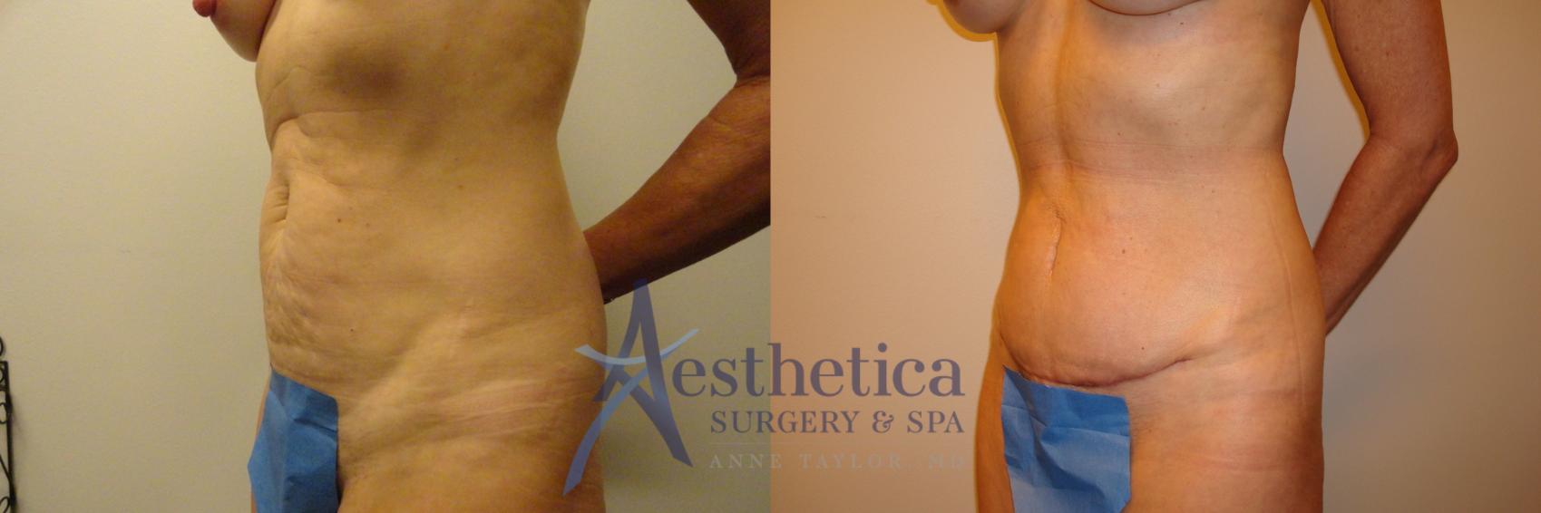 Tummy Tuck Case 197 Before & After View #2 | Columbus, OH | Aesthetica Surgery & Spa