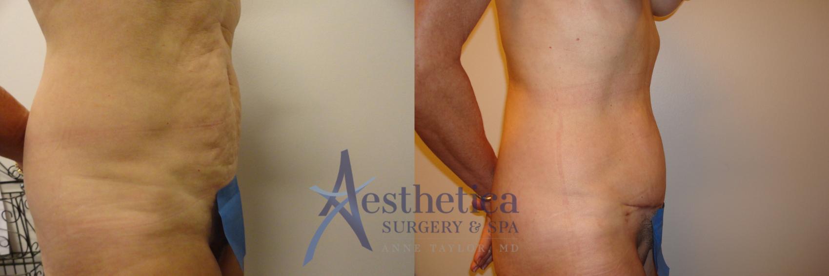 Tummy Tuck Case 197 Before & After View #3 | Columbus, OH | Aesthetica Surgery & Spa