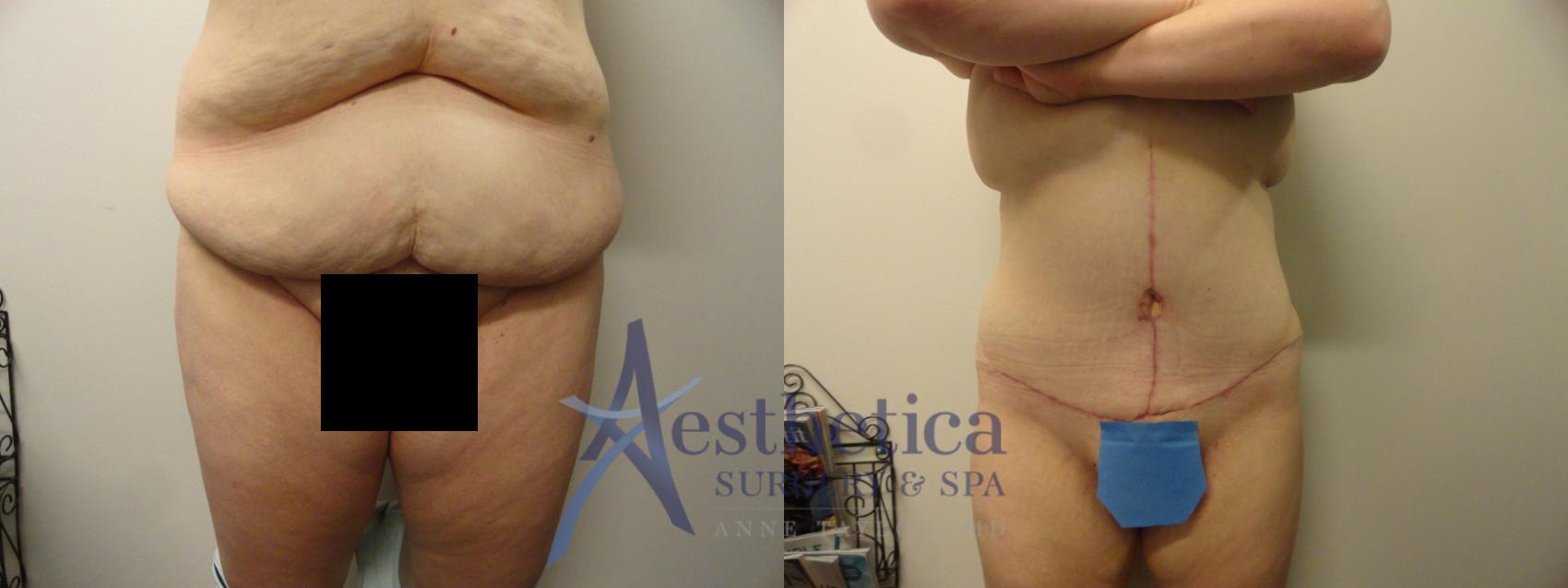 Tummy Tuck Case 243 Before & After View #1 | Columbus, OH | Aesthetica Surgery & Spa