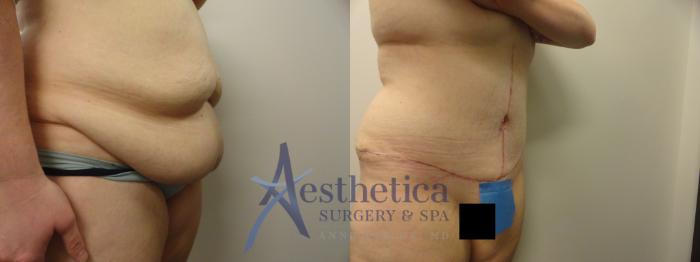 Tummy Tuck Case 243 Before & After View #2 | Columbus, OH | Aesthetica Surgery & Spa