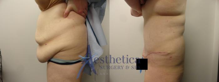 Tummy Tuck Case 243 Before & After View #3 | Columbus, OH | Aesthetica Surgery & Spa