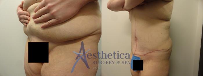 Tummy Tuck Case 243 Before & After View #4 | Columbus, OH | Aesthetica Surgery & Spa