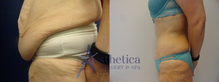 Tummy Tuck Case 289 Before & After View #3 | Columbus, OH | Aesthetica Surgery & Spa