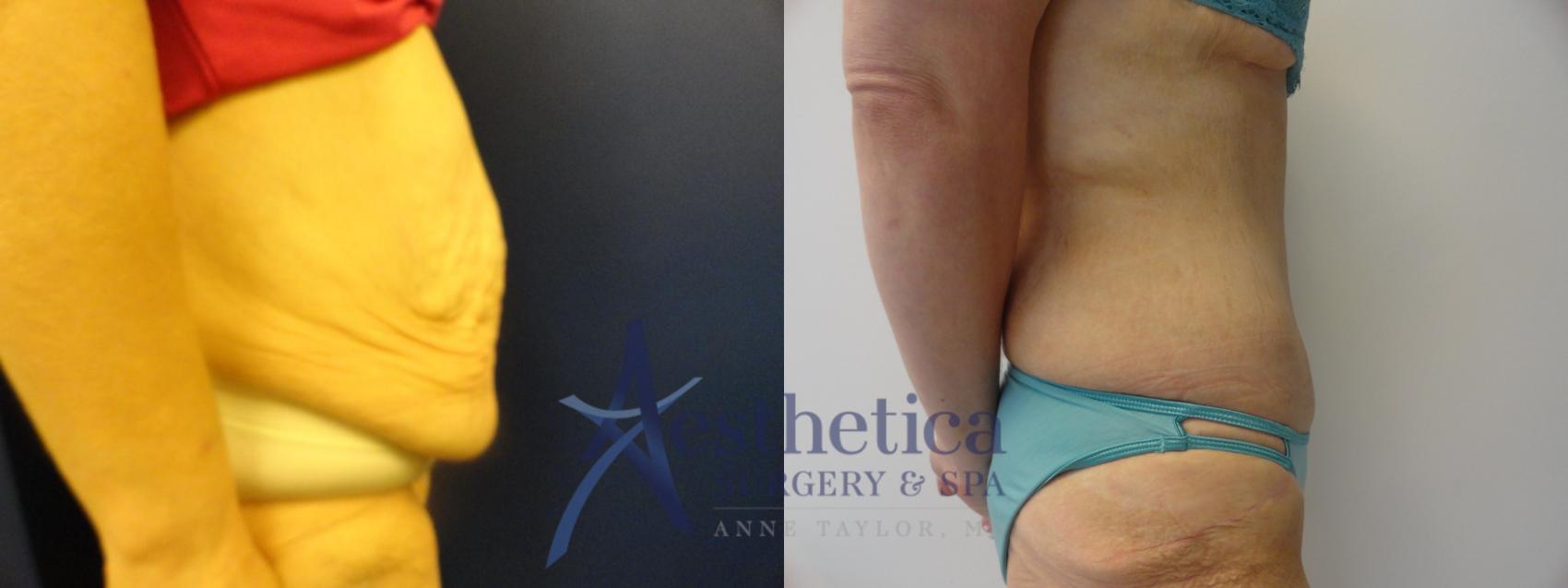 Tummy Tuck Case 289 Before & After View #4 | Columbus, OH | Aesthetica Surgery & Spa