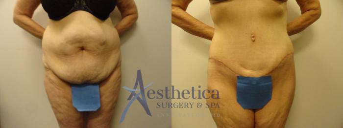 Tummy Tuck Case 291 Before & After View #1 | Columbus, OH | Aesthetica Surgery & Spa
