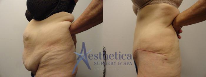 Tummy Tuck Case 291 Before & After View #3 | Columbus, OH | Aesthetica Surgery & Spa