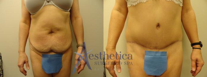 Tummy Tuck Case 293 Before & After View #1 | Columbus, OH | Aesthetica Surgery & Spa