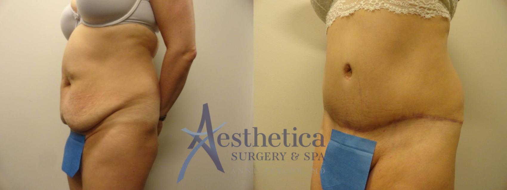 Tummy Tuck Case 293 Before & After View #2 | Columbus, OH | Aesthetica Surgery & Spa