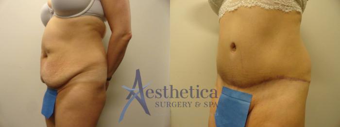Tummy Tuck Case 293 Before & After View #2 | Columbus, OH | Aesthetica Surgery & Spa
