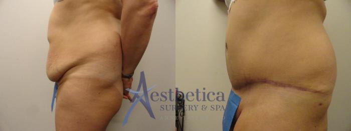 Tummy Tuck Case 293 Before & After View #3 | Columbus, OH | Aesthetica Surgery & Spa